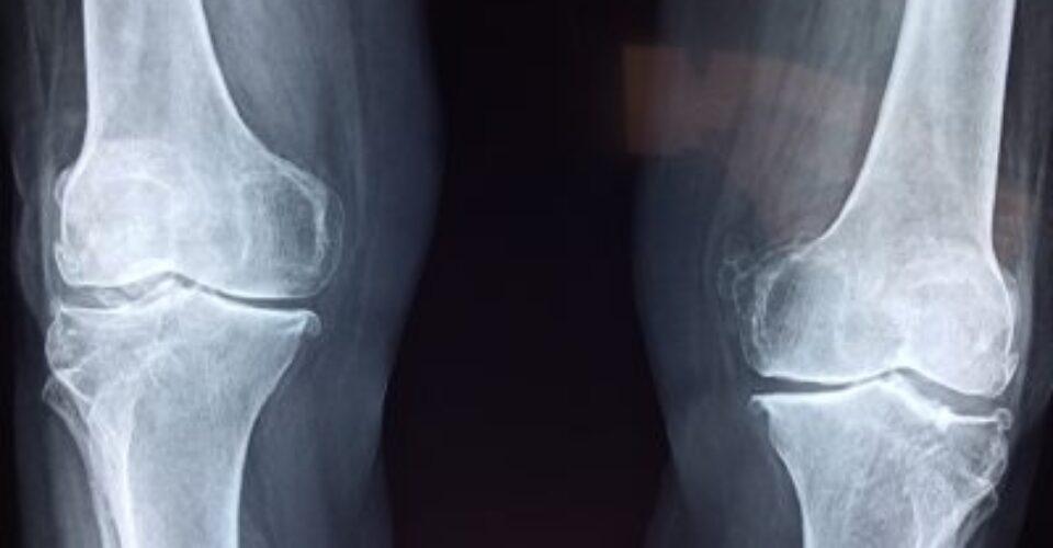 Highlighting an invisible illness; imaging for osteoarthritis